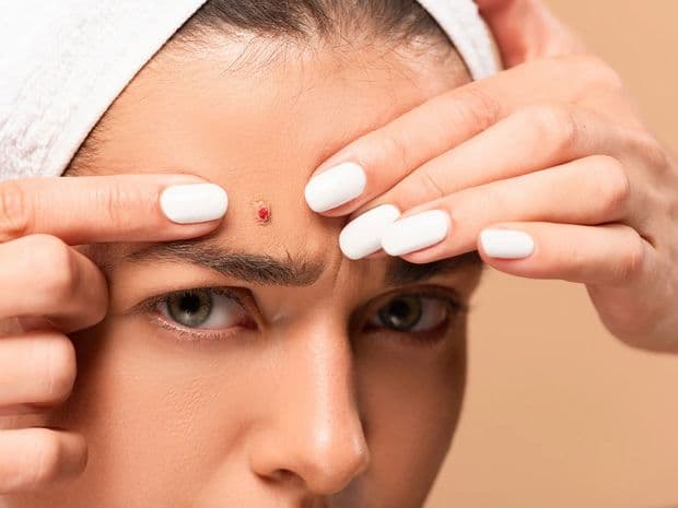Прыщи на лбу
