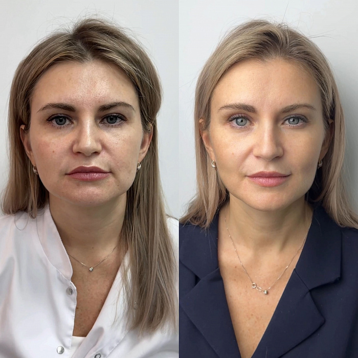 До Процедура: Fotona 4D 3 процедуры + SMAS лифтинг 400 линий + контурная пластика + полимолочная кислота
